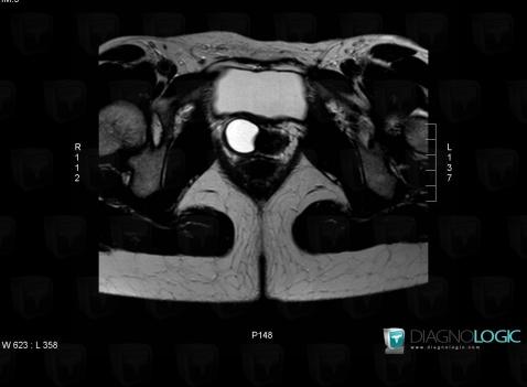 Gartner duct cyst, Vagina, MRI