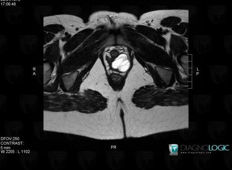 Gartner duct cyst, Vagina, MRI