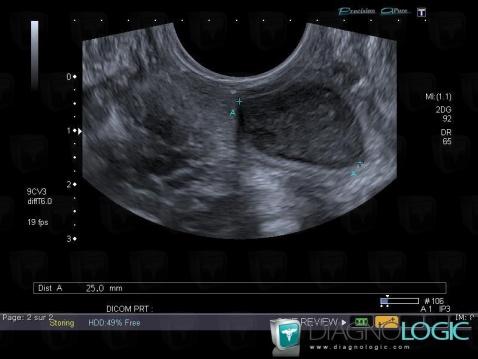 Radiology case : Gartner duct cyst (MRI ,US) - Diagnologic