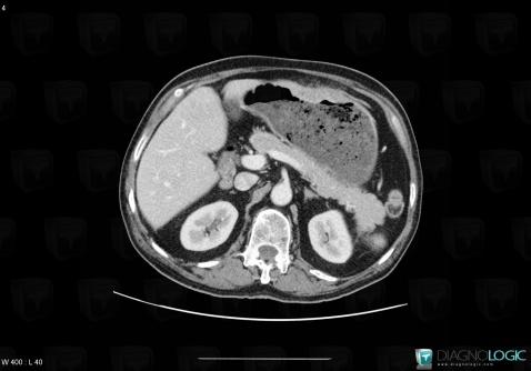 Gastric carcinoma, Stomach, CT