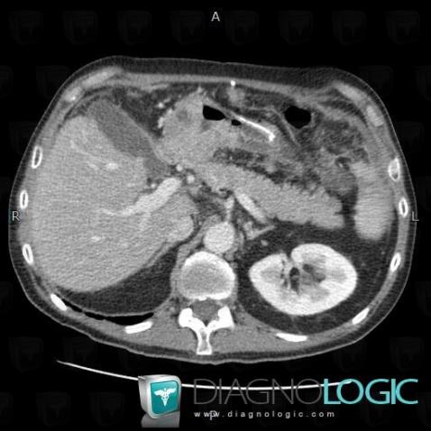 Gastric carcinoma, Stomach, CT