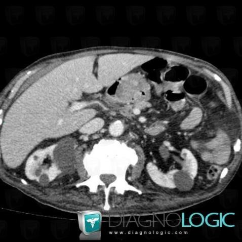 Gastric carcinoma, Stomach, CT