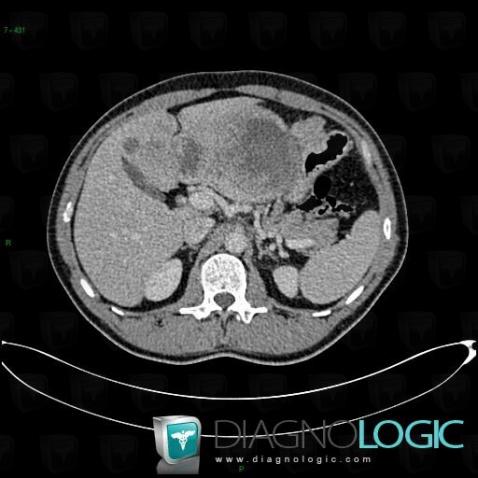 Gastrointestinal stromal tumor, Mesentery / Peritoneum, CT