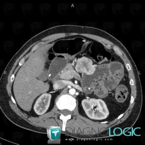 Gastrointestinal stromal tumor, Small bowel, CT