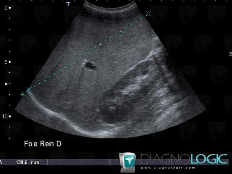 Gaucher disease, Liver, US