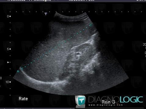 Gaucher disease, Spleen, US