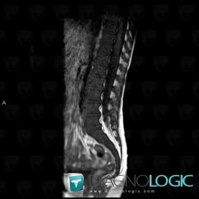 Gaucher disease, Vertebral body / Disk, MRI