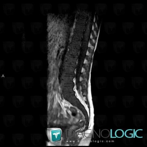 Gaucher disease, Vertebral body / Disk, MRI