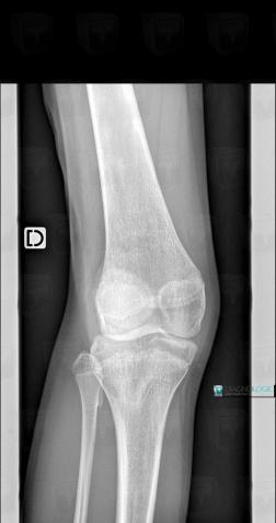 Genu valgum, Femur - Distal part, X rays