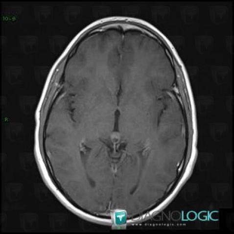 Germinoma, Pineal region, MRI