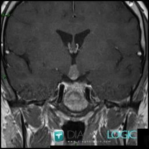 Germinoma, Pituitary gland and parasellar region, MRI