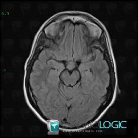 Germinoma, Pituitary gland and parasellar region, MRI