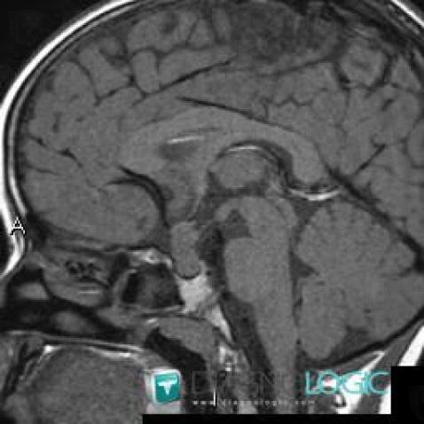 Germinoma, Pituitary gland and parasellar region, MRI