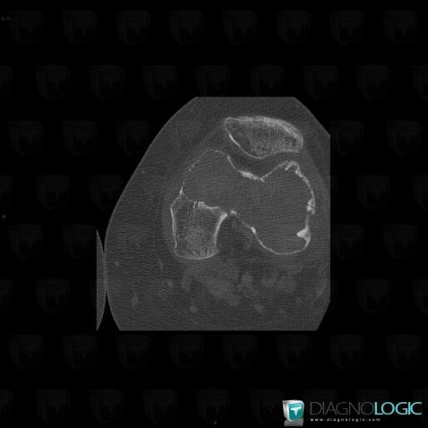 Giant cell tumor, Femur - Distal part, CT