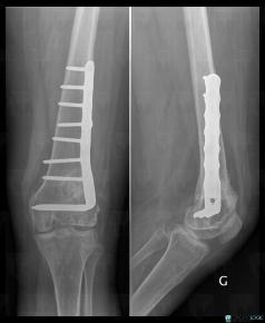 Giant cell tumor, Femur - Distal part, X rays