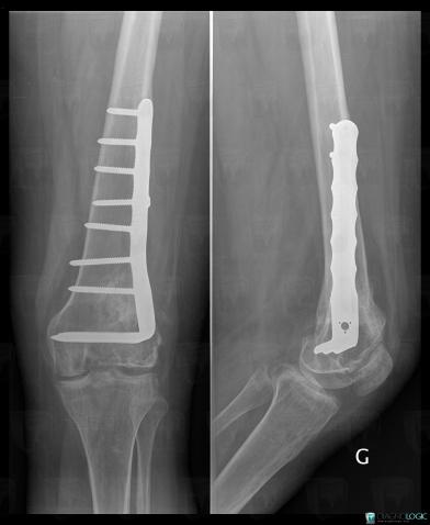 Giant cell tumor, Femur - Distal part, X rays