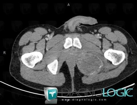 Giant cell tumor, Ilium, CT