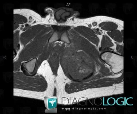 Giant cell tumor, Ilium, MRI