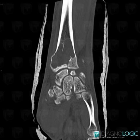 Giant cell tumor, Radius - Distal part, CT