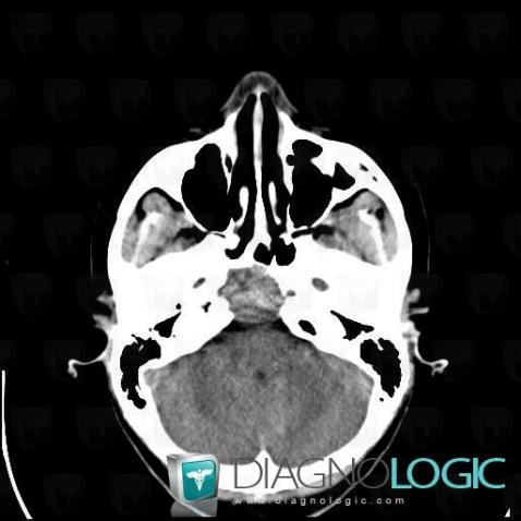 Giant cell tumor, Sphenoid bone, CT