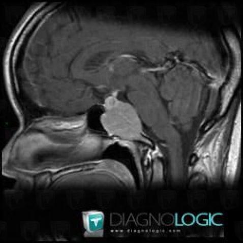 Giant cell tumor, Sphenoid bone, MRI