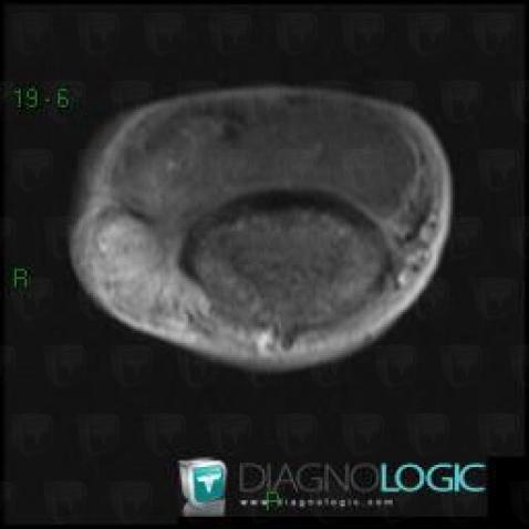 Giant cell tumor-tendon sheath, Interphalangeal joint - Hand, MRI