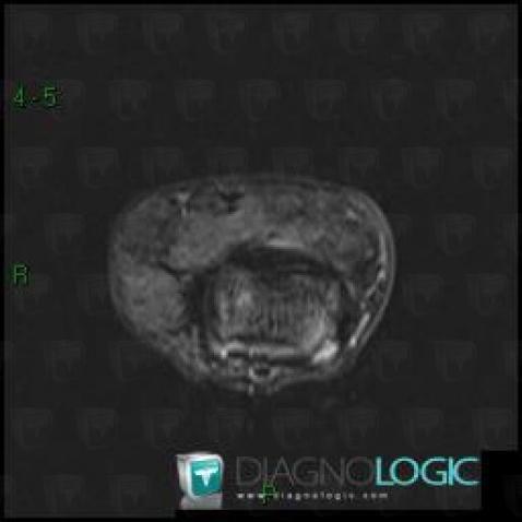 Giant cell tumor-tendon sheath, Interphalangeal joint - Hand, Other soft tissues/nerves - Hand, MRI