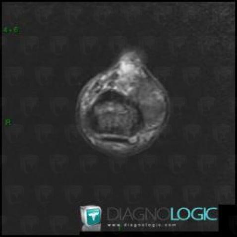 Giant cell tumor-tendon sheath, Interphalangeal joint - Hand, Other soft tissues/nerves - Hand, MRI