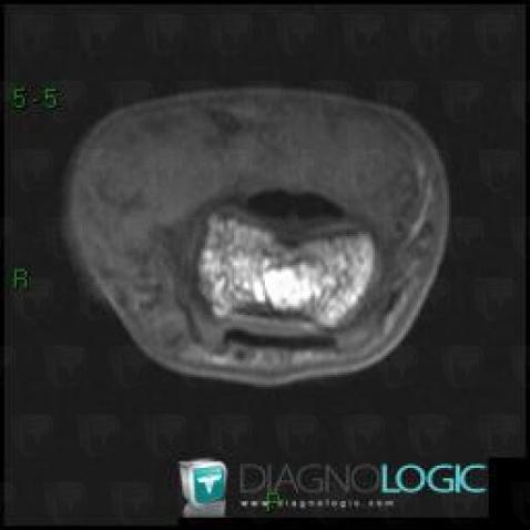 Giant cell tumor-tendon sheath, Phalanx / Sesamoid bones - Hand, Other soft tissues/nerves - Hand, MRI