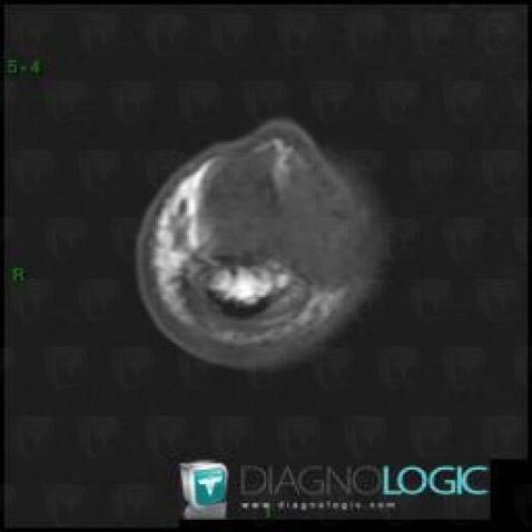 Giant cell tumor-tendon sheath, Phalanx / Sesamoid bones - Hand, Other soft tissues/nerves - Hand, MRI