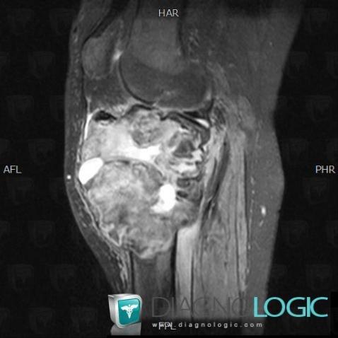 Giant cell tumor, Tibia - Proximal part, MRI