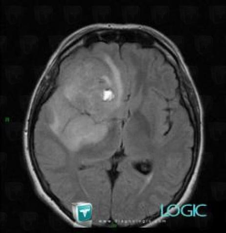 Glioblastoma multiforme, Basal ganglia and capsule, MRI