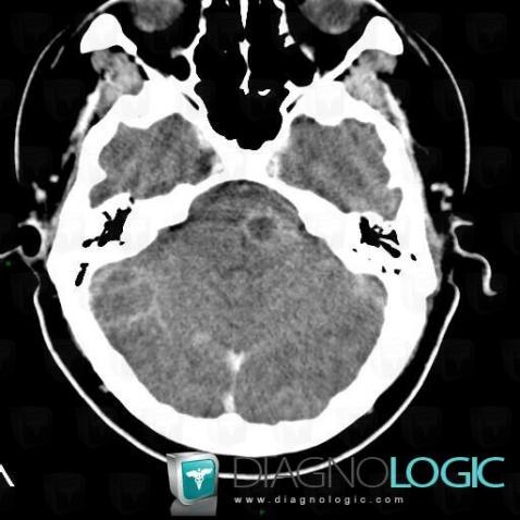 Glioblastoma multiforme, Brainstem, CT