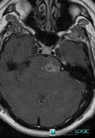 Glioblastoma multiforme, Brainstem, MRI