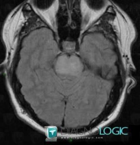 Glioblastoma multiforme, Brainstem, MRI