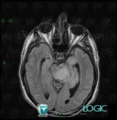 Glioblastoma multiforme, Brainstem, MRI