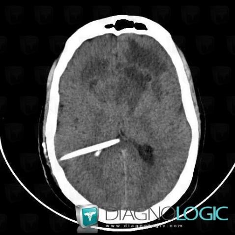 Glioblastoma multiforme, Cerebral hemispheres, Basal ganglia and capsule, CT