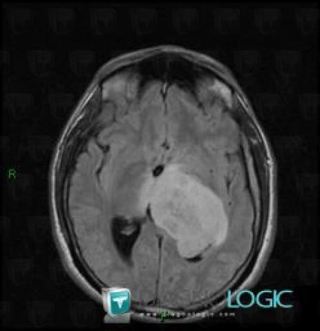 Glioblastoma multiforme, Cerebral hemispheres, Basal ganglia and capsule, MRI