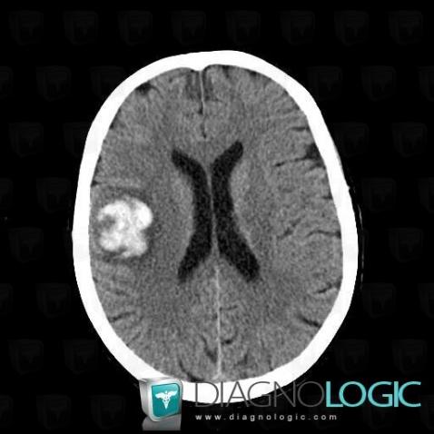 Glioblastoma multiforme, Cerebral hemispheres, CT