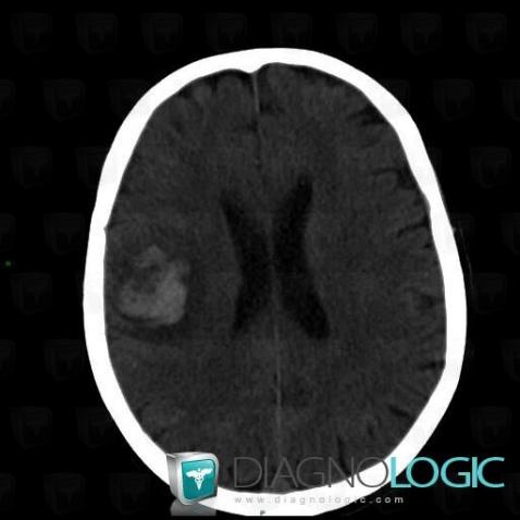 Glioblastoma multiforme, Cerebral hemispheres, CT