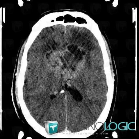 Glioblastoma multiforme, Cerebral hemispheres, CT