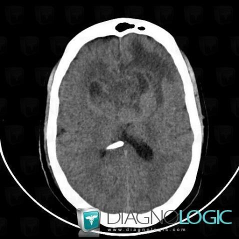 Glioblastoma multiforme, Cerebral hemispheres, CT