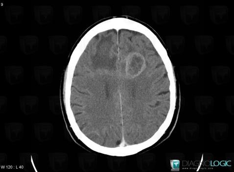 Glioblastoma multiforme, Cerebral hemispheres, CT