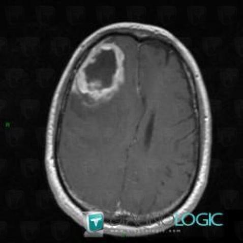 Glioblastoma multiforme, Cerebral hemispheres, MRI