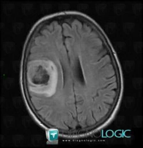 Glioblastoma multiforme, Cerebral hemispheres, MRI