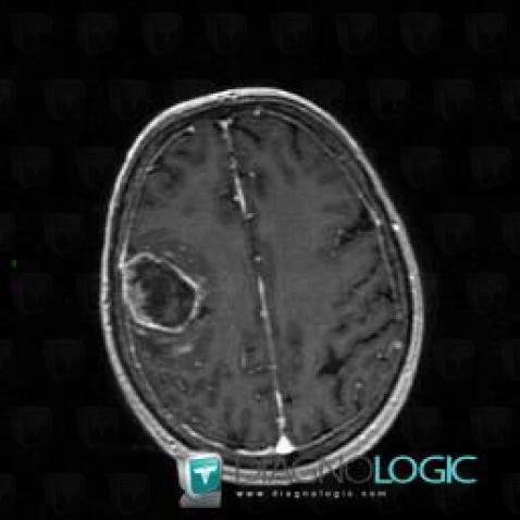 Glioblastoma multiforme, Cerebral hemispheres, MRI