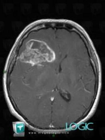 Glioblastoma multiforme, Cerebral hemispheres, MRI