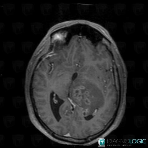 Glioblastoma multiforme, Cerebral hemispheres, MRI