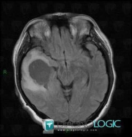 Glioblastoma multiforme, Cerebral hemispheres, MRI