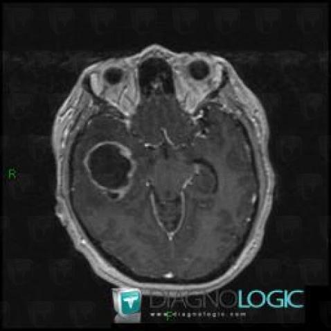 Glioblastoma multiforme, Cerebral hemispheres, MRI